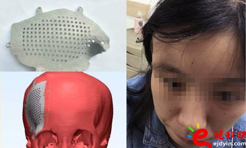 醫療3d打印應用,醫用3d打印,3D打印假肢,3D打印脊椎,3D打印心臟,e鍵打印,3d打印服務 3D打印的顱骨假體，非常適用于發際外的顱骨缺損、病變置換，將使患者的面容恢復到正常形態，完美解決了傳統顱骨修補存在的美容問題。據悉，3D打印個性化顱骨假體修補技術已獲國家重點研發計劃資助，能為一批病人免費提供假體，并能減免一些檢查和治療費用。未來將實行72小時的3D假體個性化顱骨修補術，造福更多的患者。