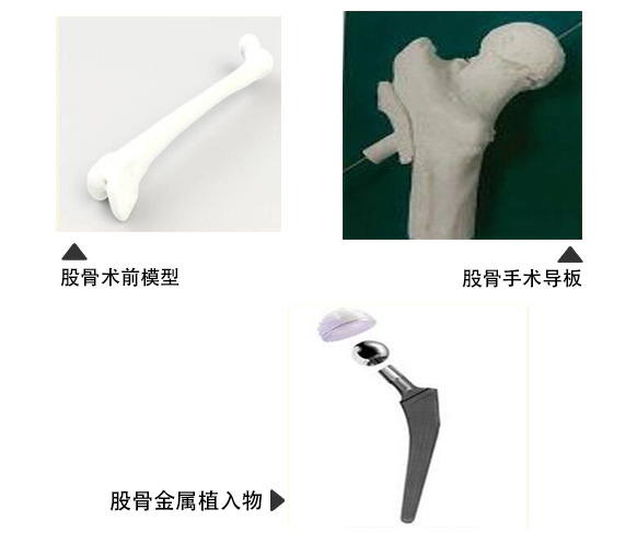 股骨金屬植入物1